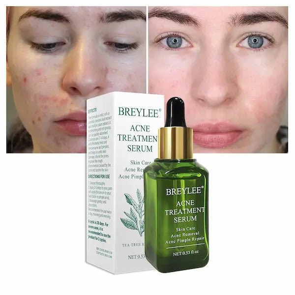 Acne Treatment & Scar Repair Serum – Plant-Powered Blemish Essence
