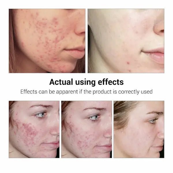Acne Treatment & Scar Repair Serum – Plant-Powered Blemish Essence