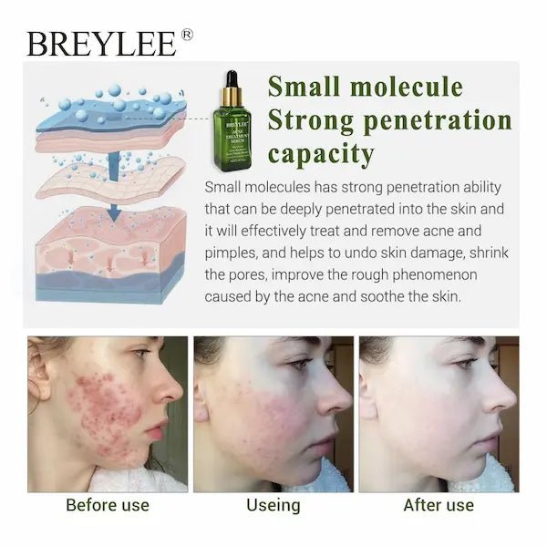 Acne Treatment & Scar Repair Serum – Plant-Powered Blemish Essence